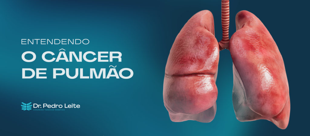 Entendendo o cancer de pulmão